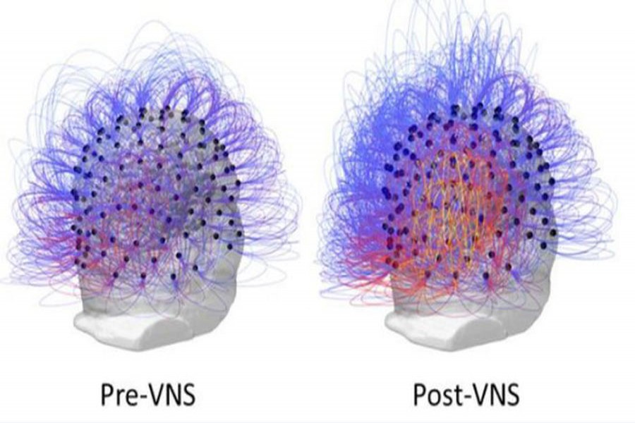 Tests show the man's brain activity before (L) and after (R) the treatment