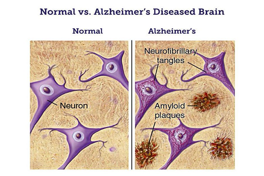 Source: BrightFocus Foundation