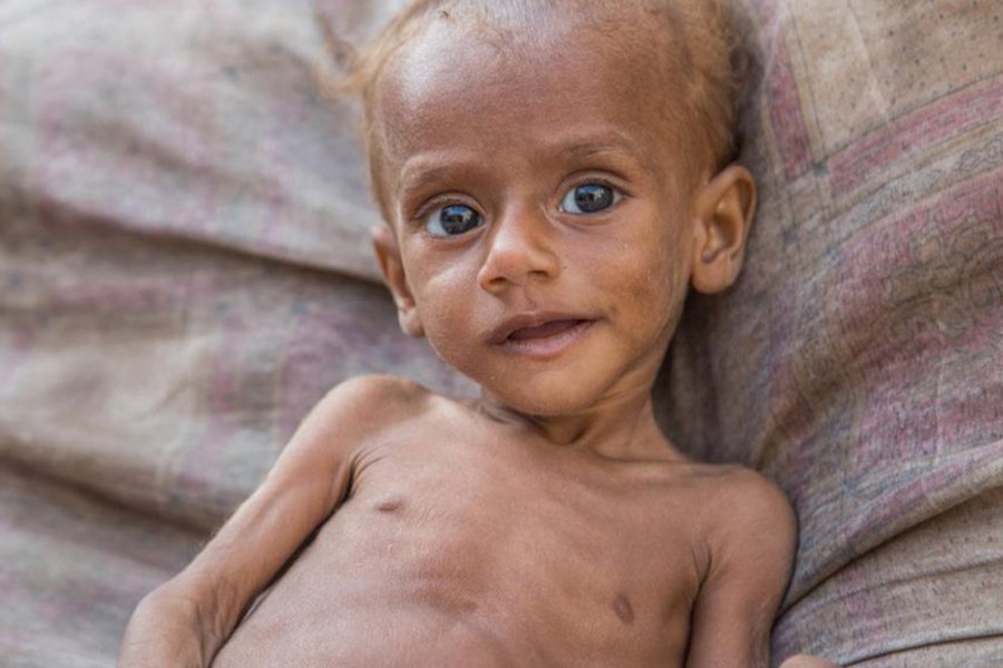 Children under the age of five are at greater risk of death from severe malnutrition.  13-month-old Nusair in Yemen. Photo: Save The Children