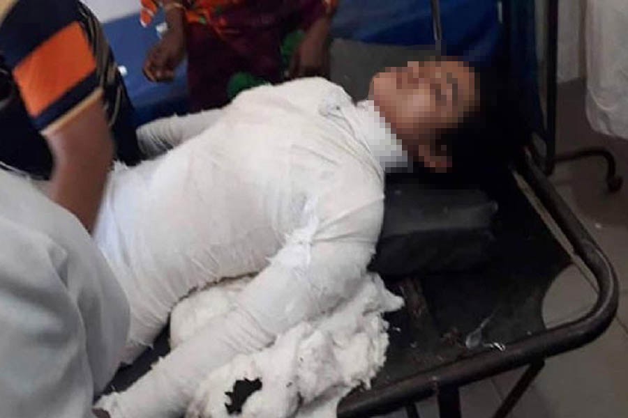 Feni madrasa student loses battle with burn injuries