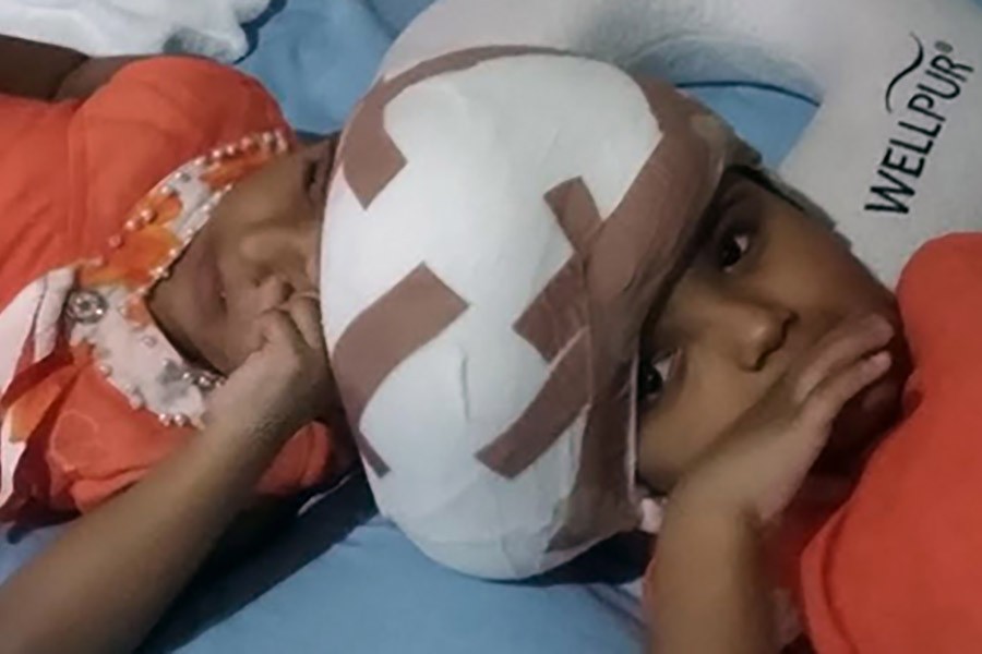 Separated conjoined twins now free from major risks