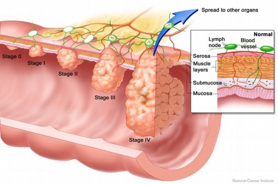 Chinese researchers develop prediction model for rectal cancer