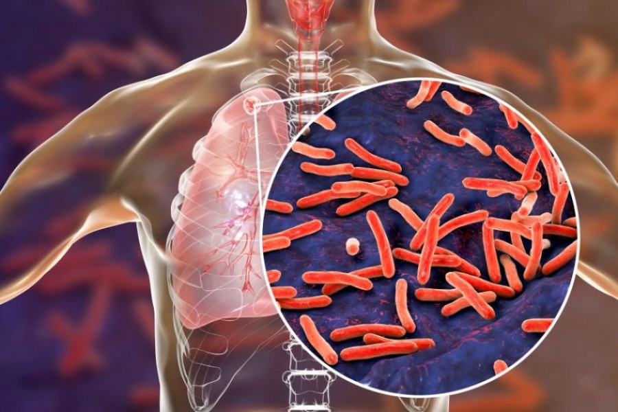 Tuberculosis remains a major public health threat: icddr,b