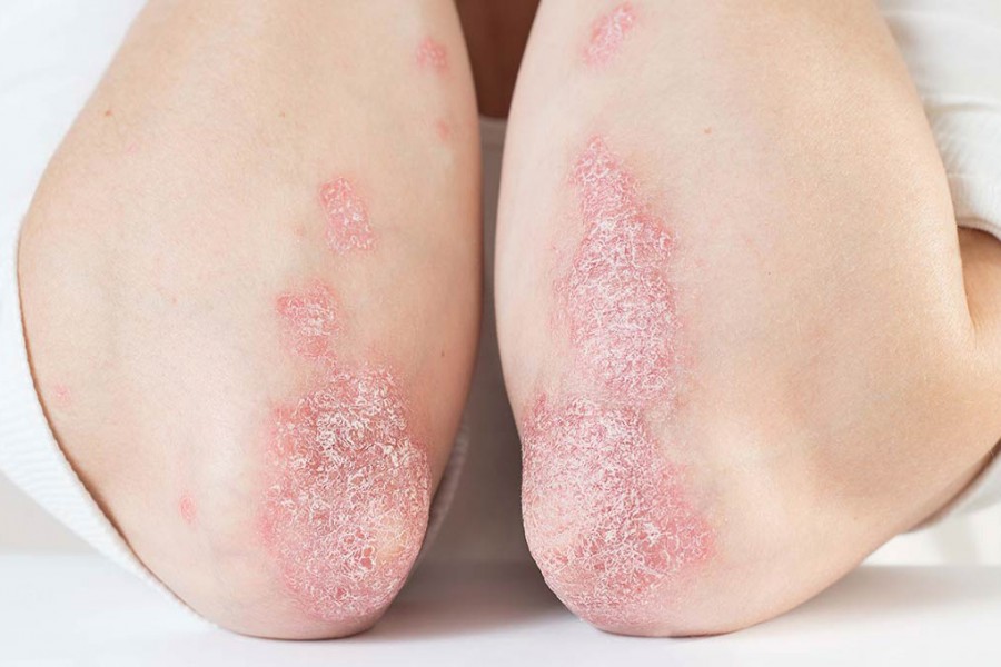 Psoriasis: More than a skin disease