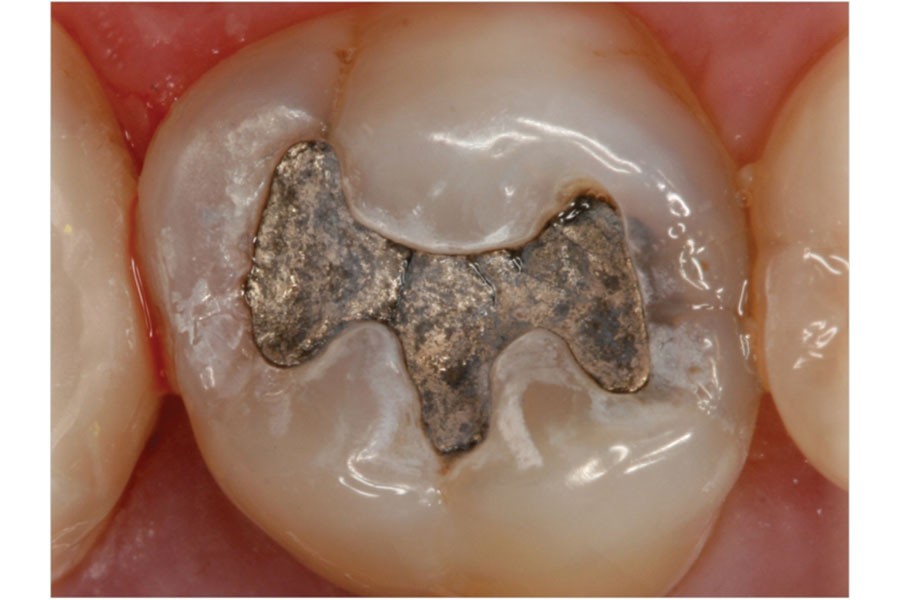 Phase-out of mercury-containing dental fillings, urges Minamata Convention  