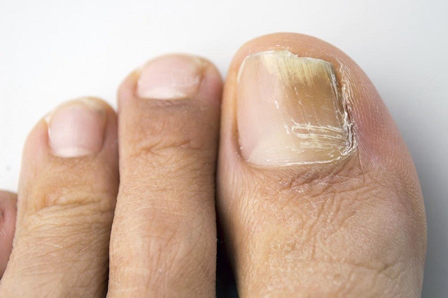 Should we worry about dead nails?