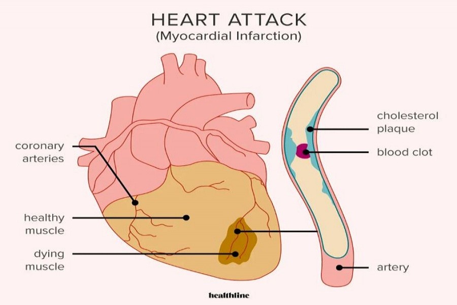 Warning signs of an impending heart attack