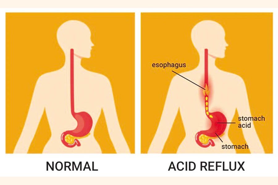 Managing occasional heartburn at home