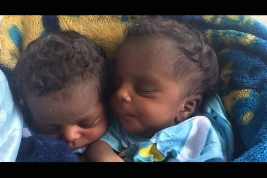 Conjoined twin girls Anick and Destin survived their birth before being separated (Photo collected from internet)