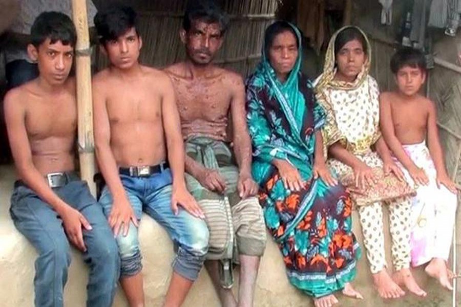 The six members of a family in Kismat Ghoragasa village of Jhenidah have been suffering from neurofibromatosis. The photo was taken on Wednesday. 	— FE Photo