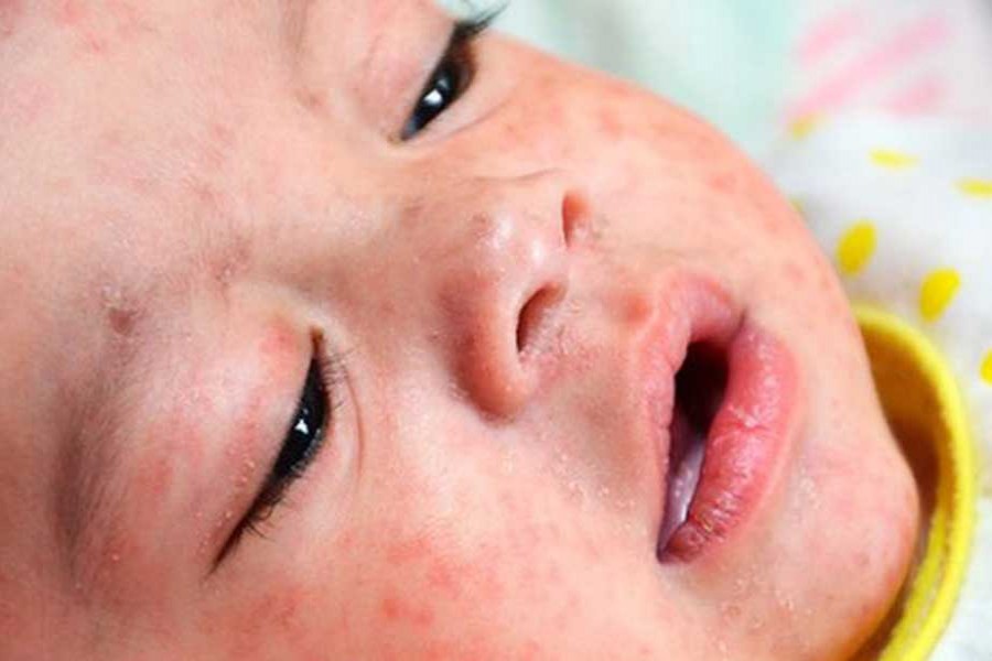 Europe sees soaring rates of measles