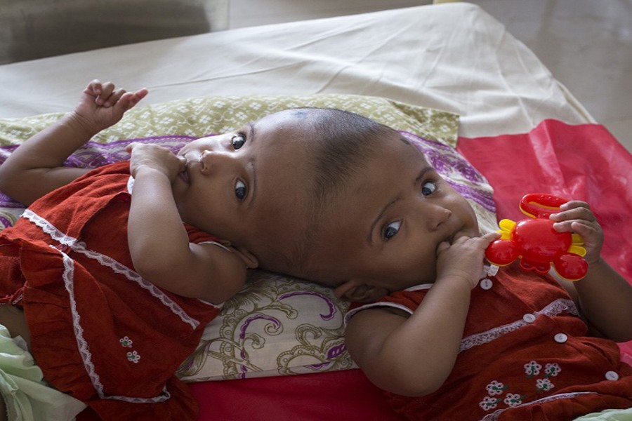 BD doctors await another successful surgery on conjoined twins