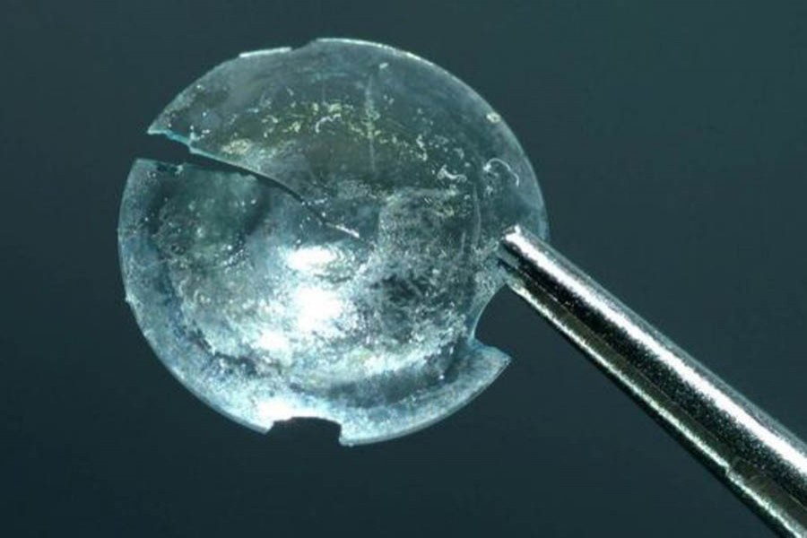 The contact lens was found lodged inside a cyst that was removed from the woman's eyelid. BMJ photo