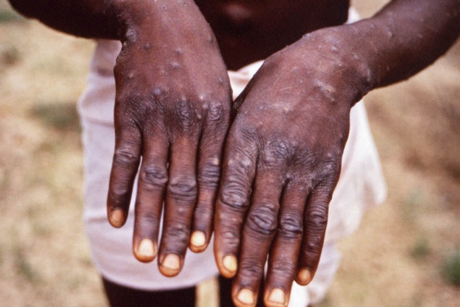 A monkeypox patient in Africa, where cases of the the viral infection are on the rise. Photo: Collected