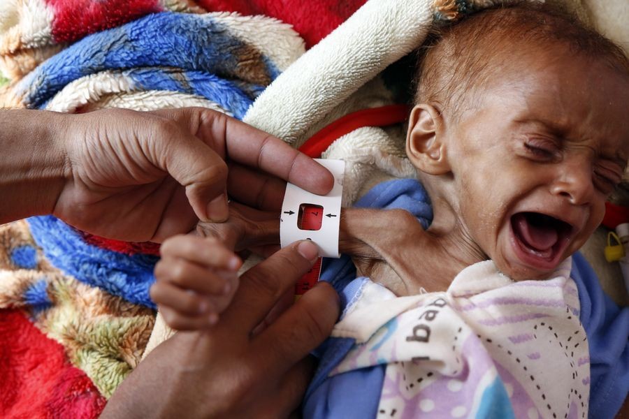 A doctor checks a malnourished child at the malnutrition treating department in Al-Sabeen hospital in Sanaa, Yemen, on Oct 17, 2019. (Xinhua/Mohammed Mohammed)