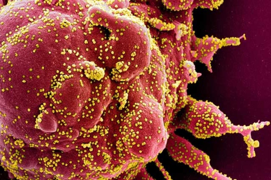 Colorised scanning electron micrograph of an apoptotic cell (red) infected with SARS-COV-2 virus particles (yellow), also known as novel coronavirus, isolated from a patient sample. Reuters