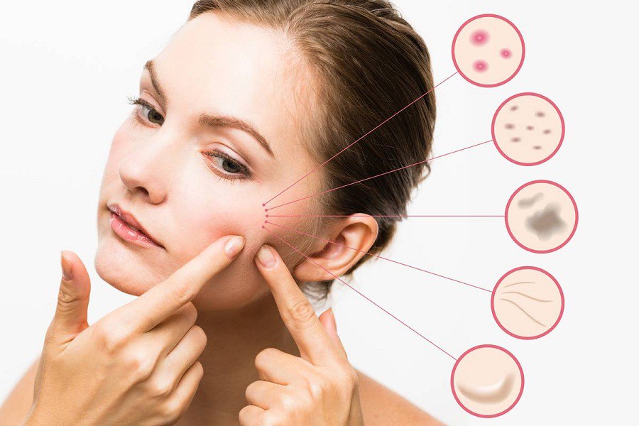 These habits can worsen your acne problems