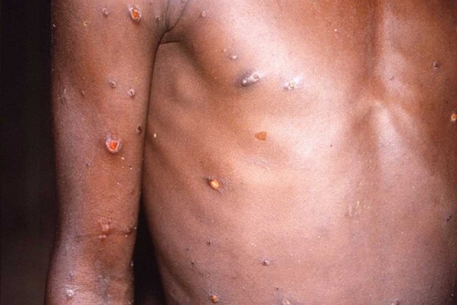 An image created during an investigation into an outbreak of monkeypox, which took place in the Democratic Republic of the Congo, 1996 to 1997, shows the arms and torso of a patient with skin lesions due to monkeypox, in this undated image obtained by Reuters on May 18, 2022. CDC via REUTERS