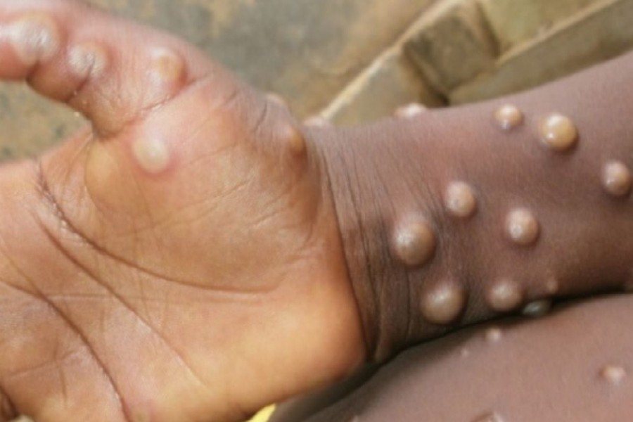 Monkeypox usually self-limiting but may be severe in some individuals: WHO