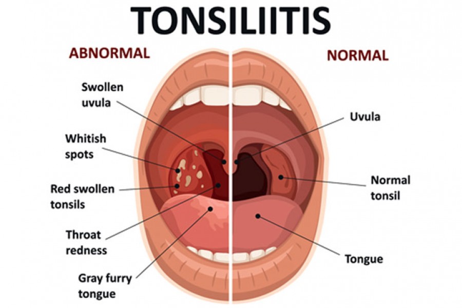 Management of Tonsillitis