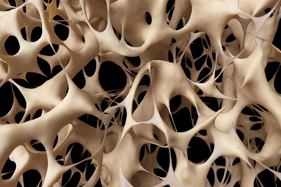 Osteoporosis: Warning signs and how to manage it
