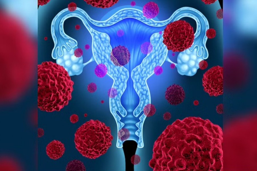 Uterus or uterine cancer medical concept as cancerous cells spreading in a female body attacking the reproductive system anatomy including ovaries and fallopian tubes as a health care symbol of cervical tumor growth treatment and risks.Alamy via Reuters Connect