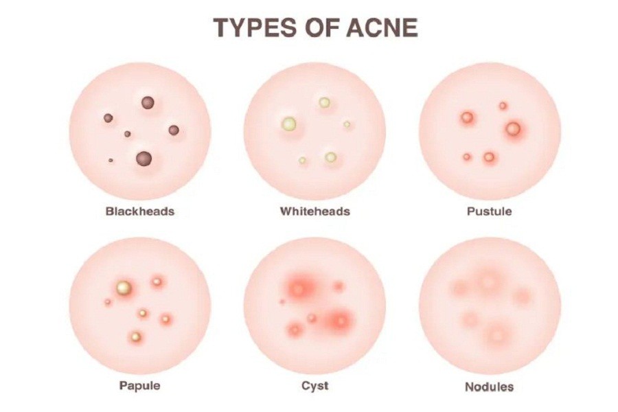 Know the types of facial acne for proper treatment