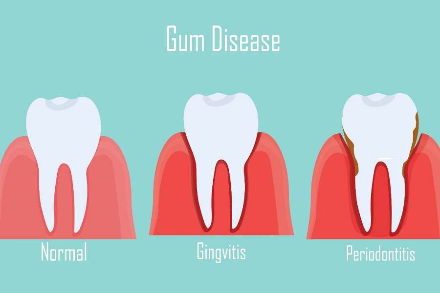 Gum bleeding: Cause, prevention and treatment 