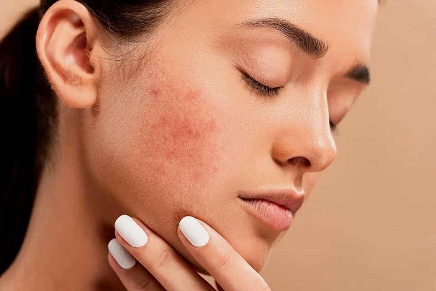Can topical treatment alone fix acne scars?